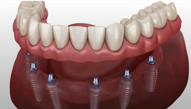 All-on-X Implants
