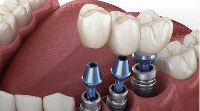 Multiple Tooth Implants