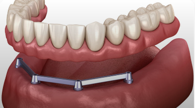 Implant Supported Denture