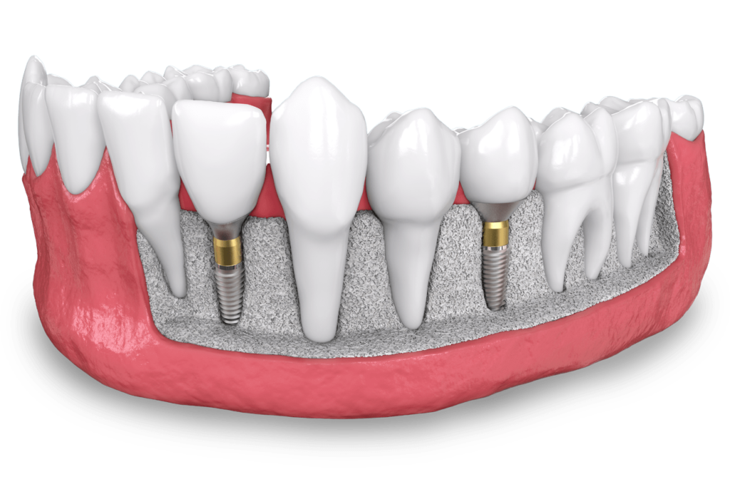 dental implant model Dana Point CA