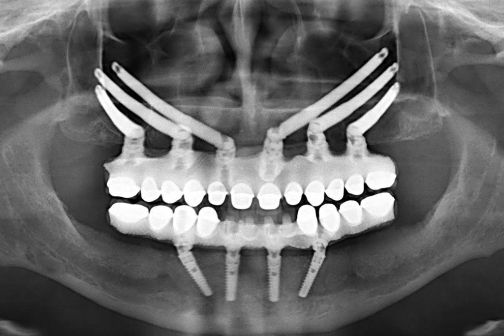 zygomatic dental implants Dana Point CA